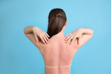Photo of Woman with sunburned skin on light blue background, back view