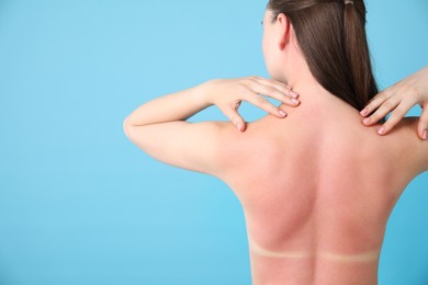 Photo of Woman with sunburned skin on light blue background, back view. Space for text