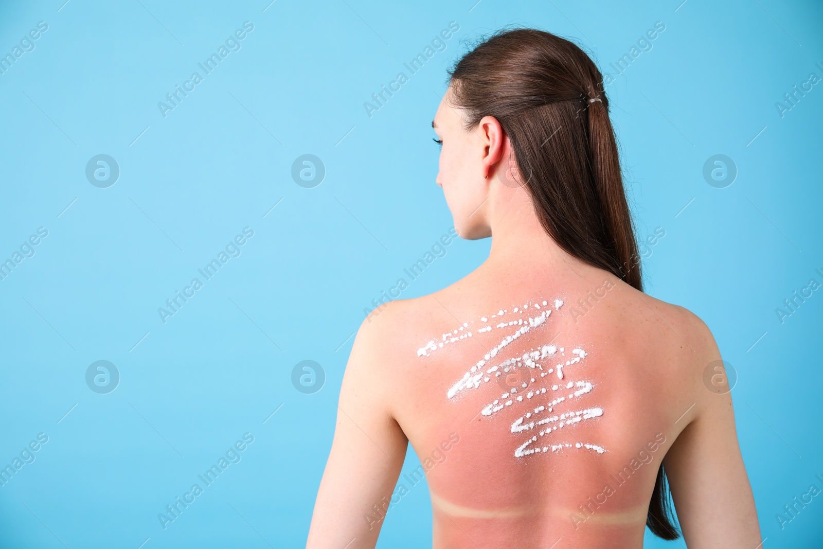 Woman with sun protection product on her sunburned skin against light blue background, back view. Space for text Photo of Woman with sun protection product on her sunburned skin against light blue background, back view. Space for text