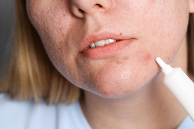 Photo of Woman applying cream onto face, closeup. Acne treatment