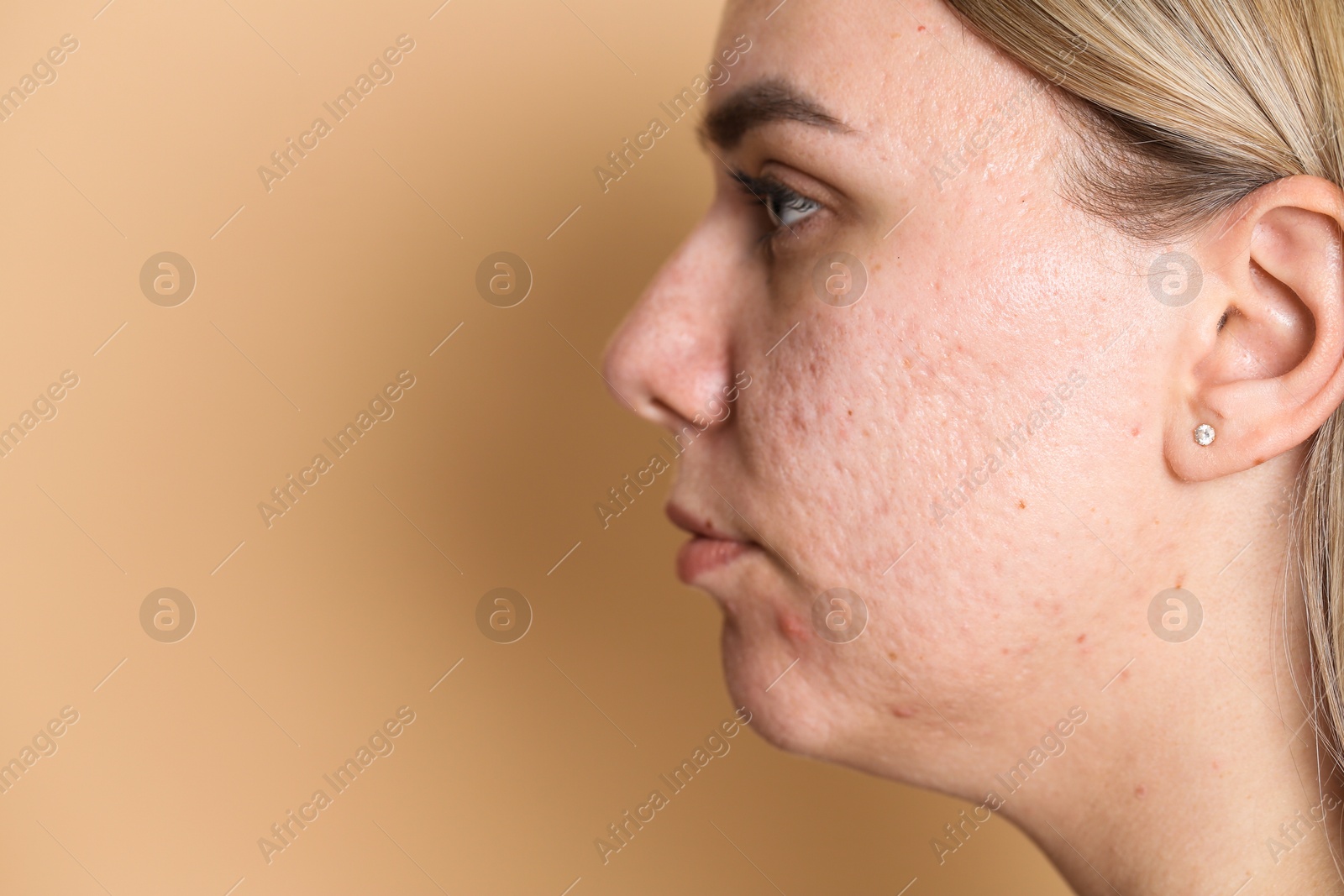 Photo of Woman with acne problem on beige background, space for text