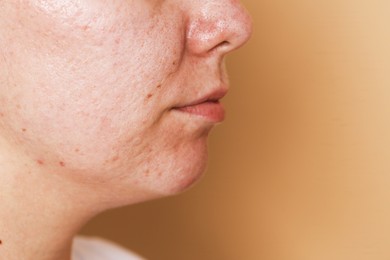 Photo of Woman with acne problem on beige background, closeup. Space for text
