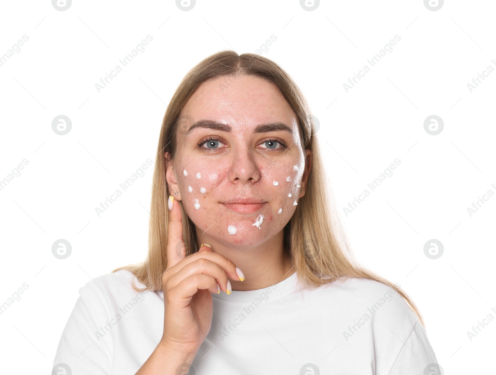 Photo of Woman applying cream onto face on white background. Acne treatment