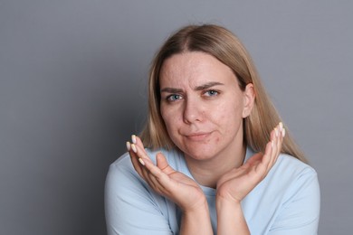 Photo of Woman with acne problem on grey background, space for text