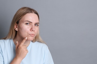 Photo of Woman with acne problem on grey background, space for text