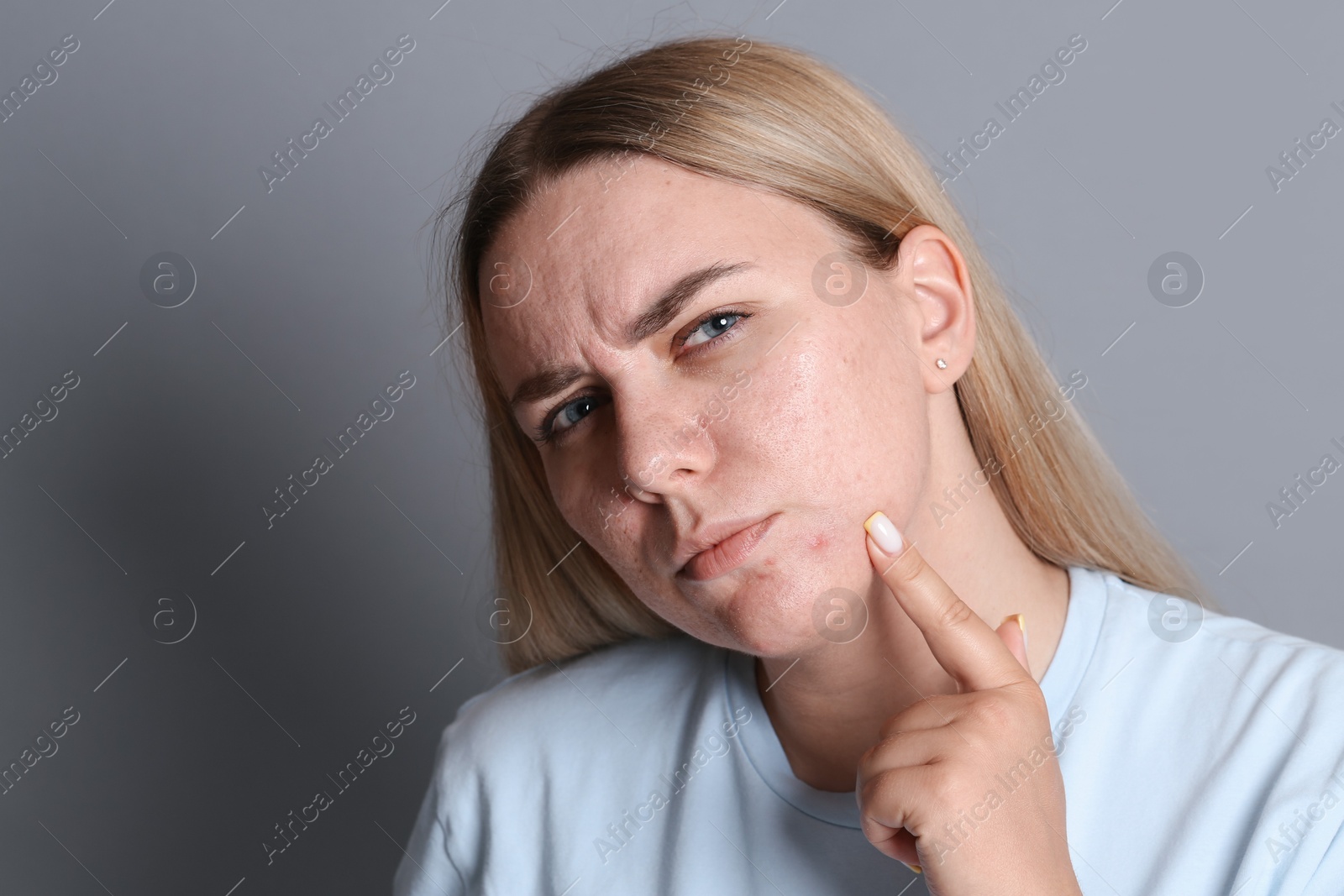 Woman with acne problem on grey background, space for text Photo of Woman with acne problem on grey background, space for text