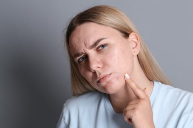 Photo of Woman with acne problem on grey background, space for text