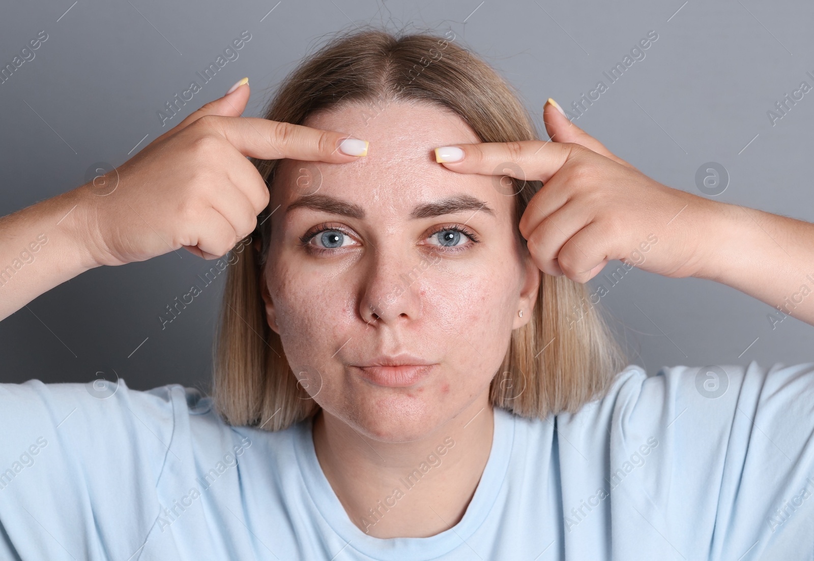 Woman with acne problem on grey background Photo of Woman with acne problem on grey background