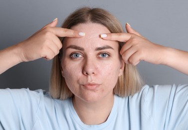 Photo of Woman with acne problem on grey background