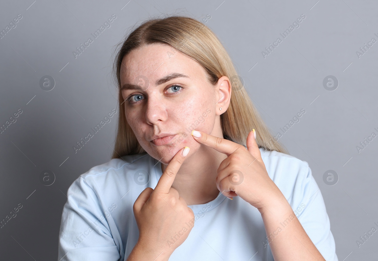 Woman with acne problem on grey background Photo of Woman with acne problem on grey background