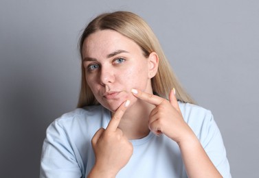 Photo of Woman with acne problem on grey background