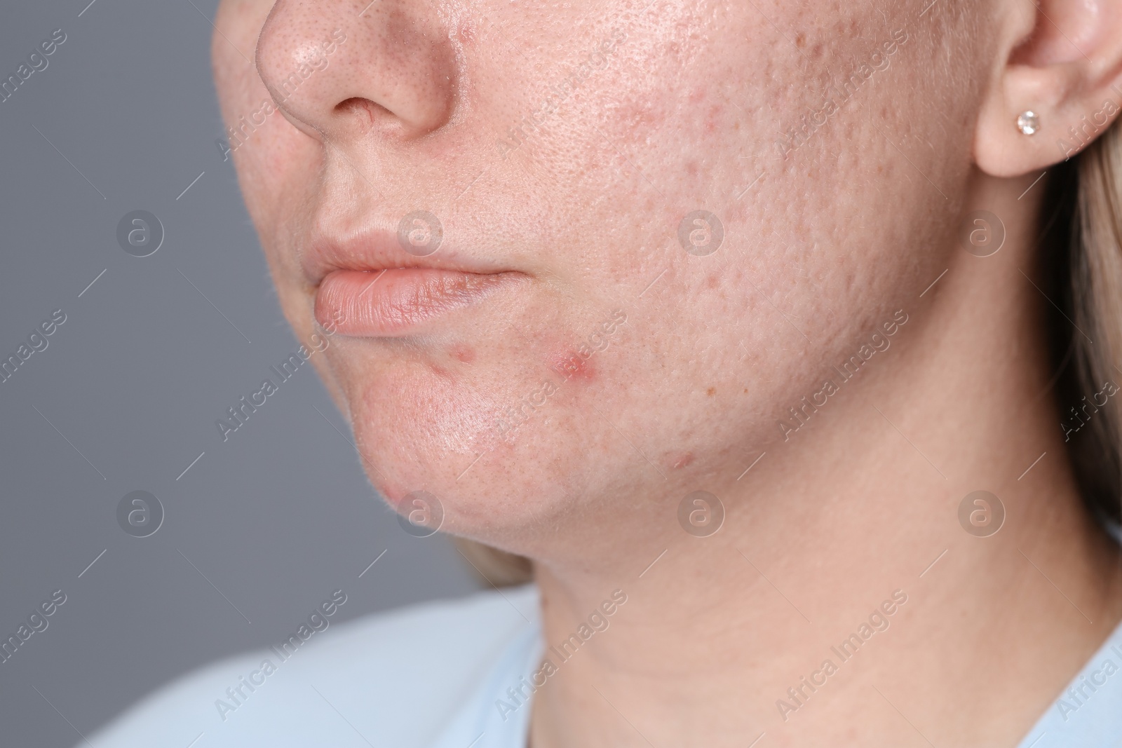 Woman with acne problem on grey background, closeup Photo of Woman with acne problem on grey background, closeup