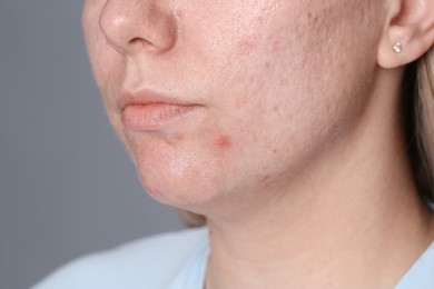 Photo of Woman with acne problem on grey background, closeup