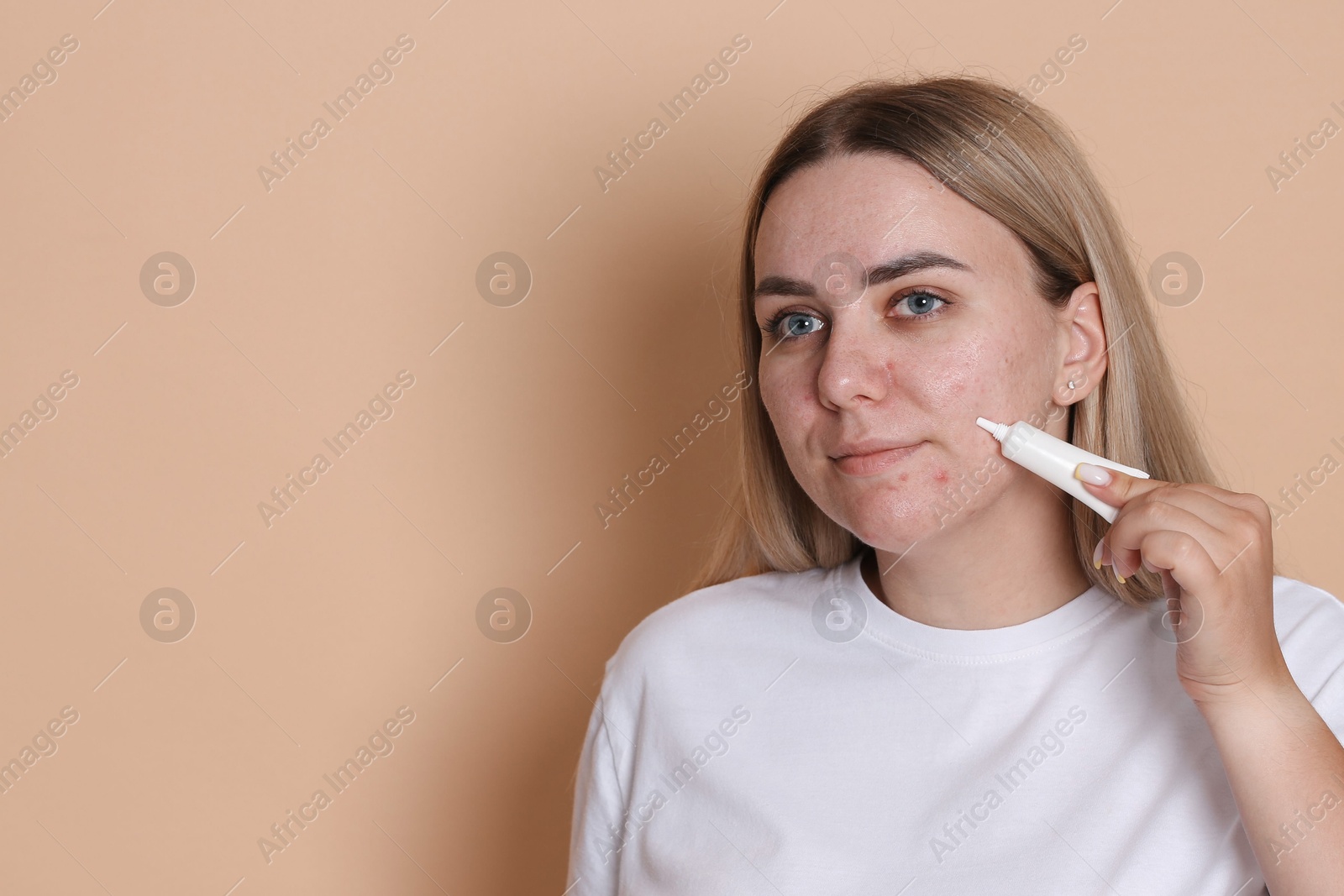 Woman applying cream onto face on beige background, space for text. Acne treatment Photo of Woman applying cream onto face on beige background, space for text. Acne treatment