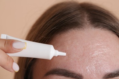Photo of Woman applying cream onto face on beige background, closeup. Acne treatment