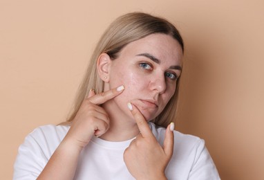 Photo of Woman with acne problem on beige background