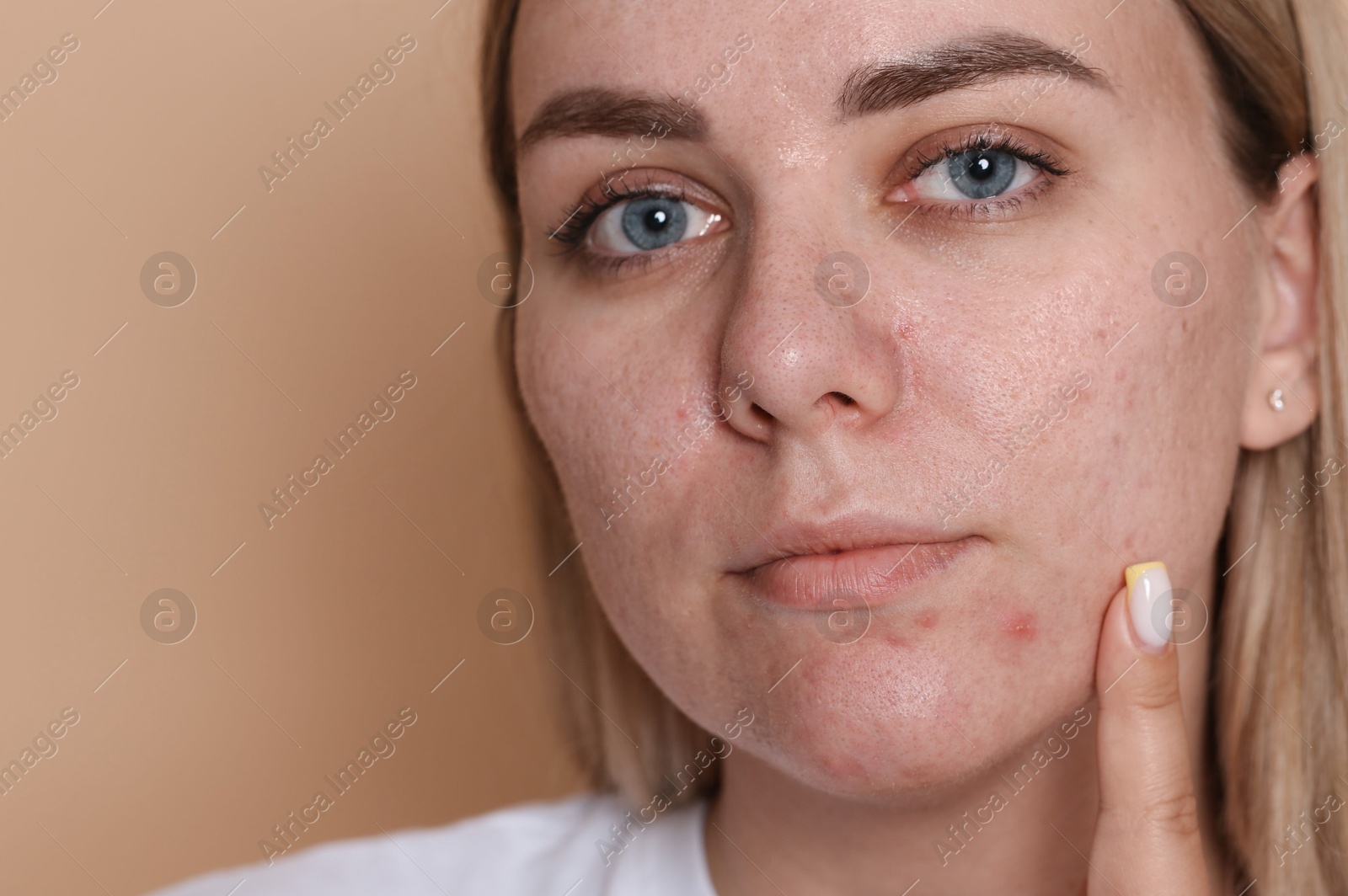 Woman with acne problem on beige background, space for text Photo of Woman with acne problem on beige background, space for text