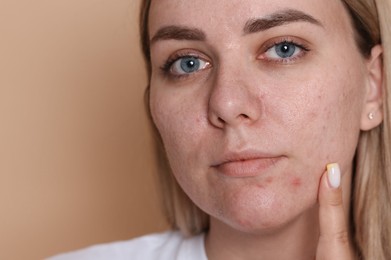Photo of Woman with acne problem on beige background, space for text