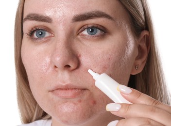 Photo of Woman applying cream onto face on white background. Acne treatment