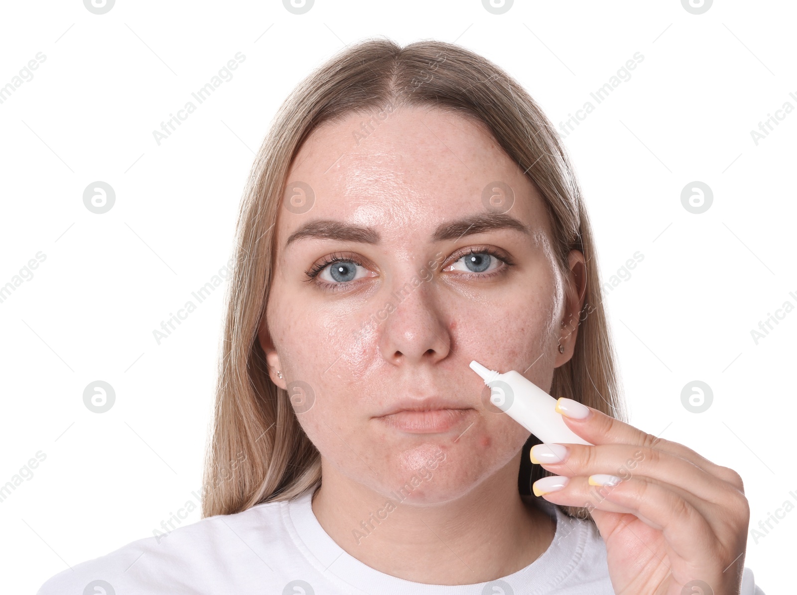 Woman applying cream onto face on white background. Acne treatment Photo of Woman applying cream onto face on white background. Acne treatment