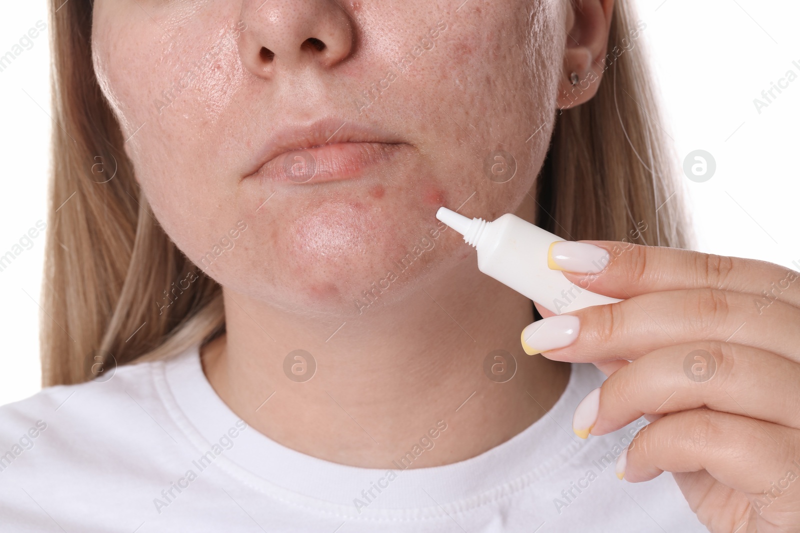 Woman applying cream onto face on white background, closeup. Acne treatment Photo of Woman applying cream onto face on white background, closeup. Acne treatment