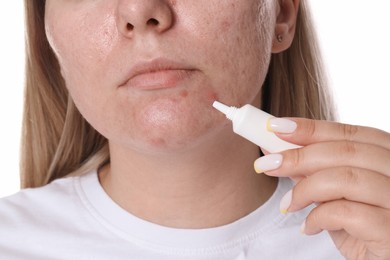 Photo of Woman applying cream onto face on white background, closeup. Acne treatment
