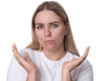 Photo of Woman with acne problem on white background