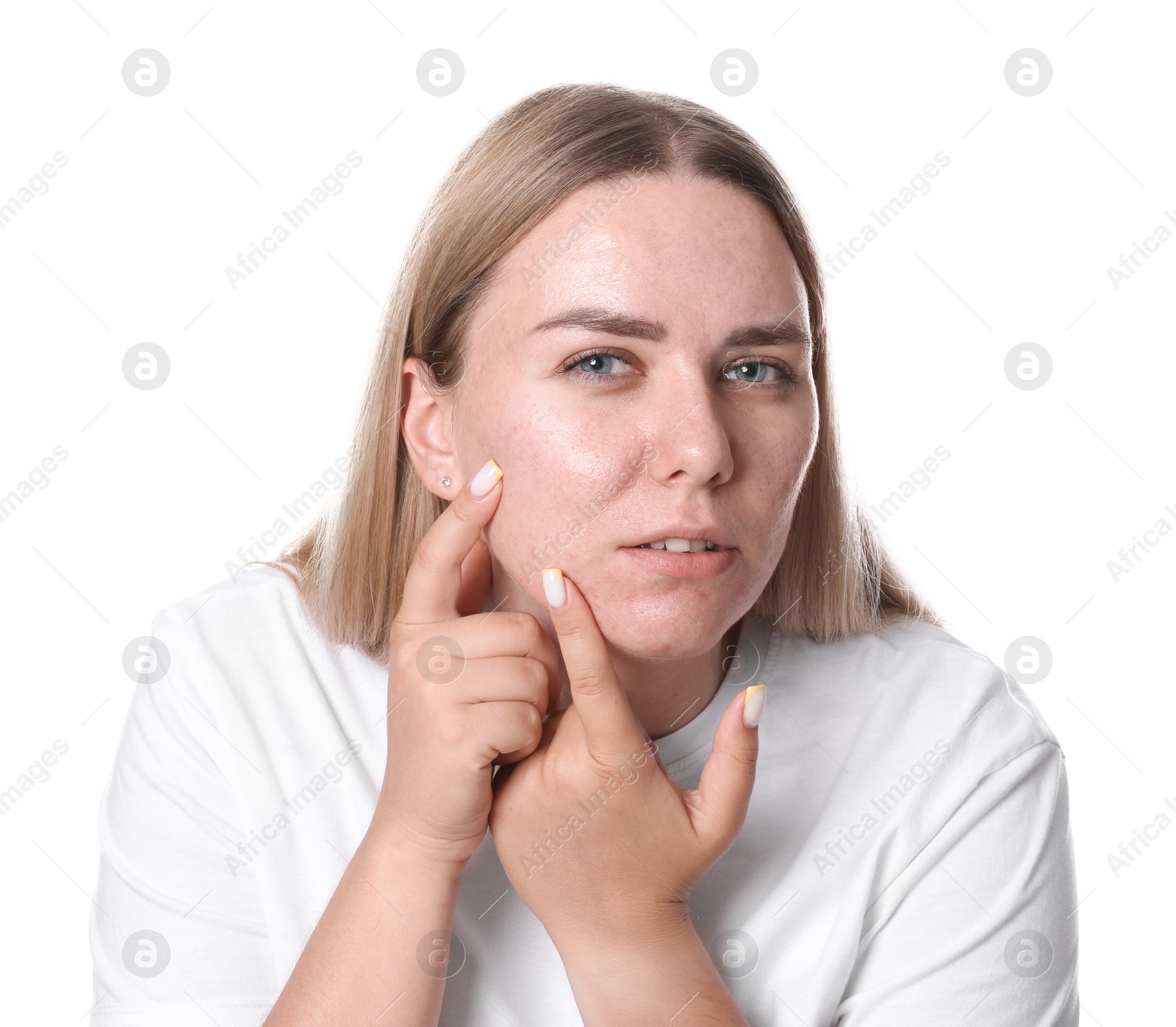 Woman with acne problem on white background Photo of Woman with acne problem on white background
