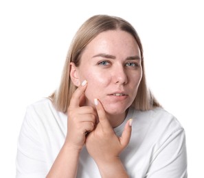Photo of Woman with acne problem on white background