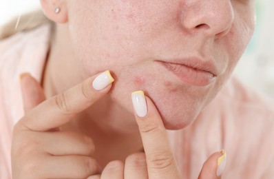 Photo of Woman popping pimple at home, closeup. Acne problem