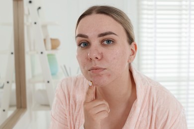 Photo of Beautiful woman with acne problem in bathroom