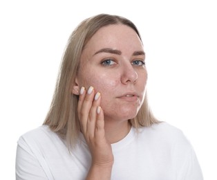 Photo of Woman with acne problem on white background