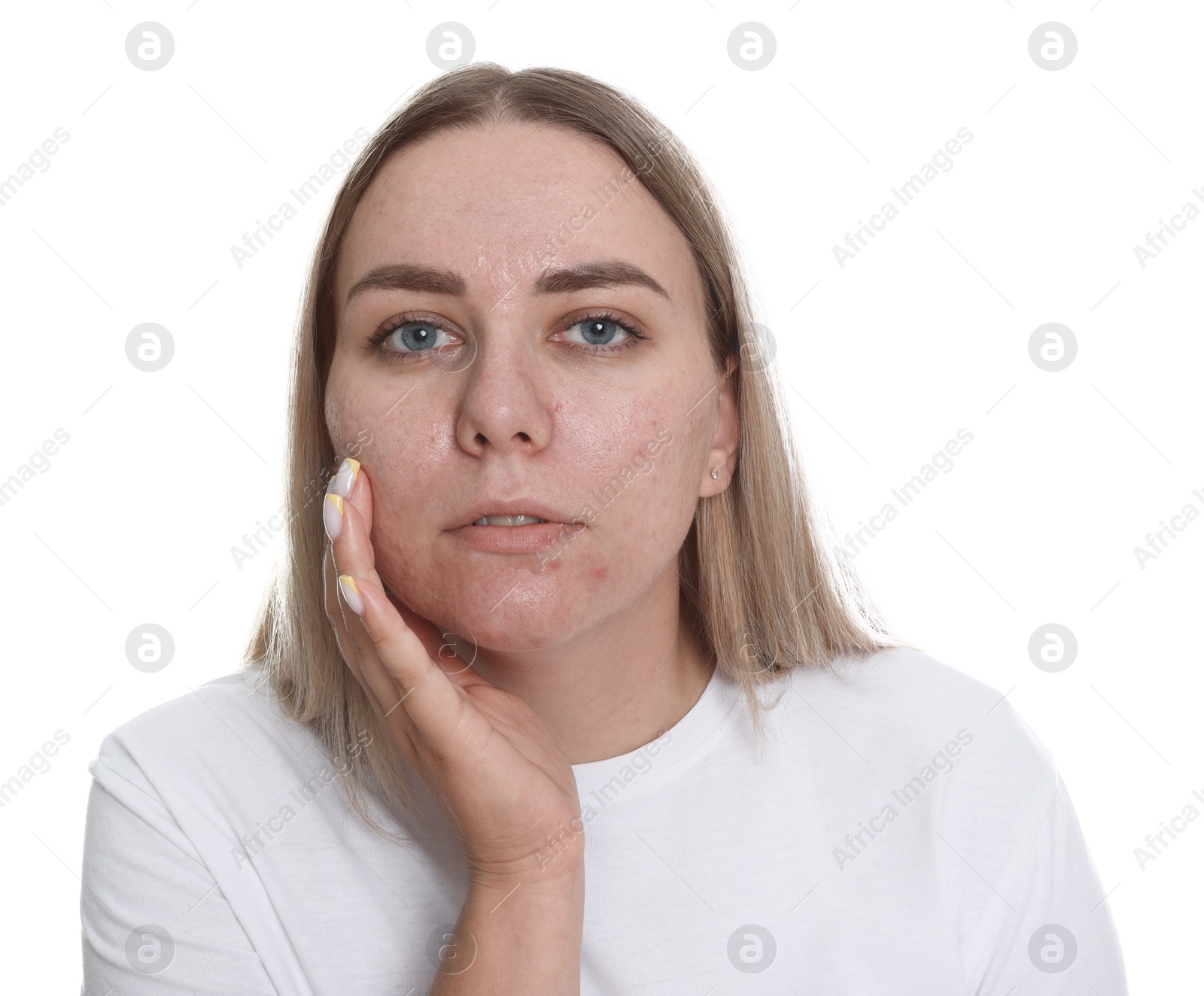 Woman with acne problem on white background Photo of Woman with acne problem on white background