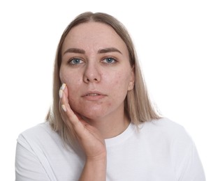 Photo of Woman with acne problem on white background