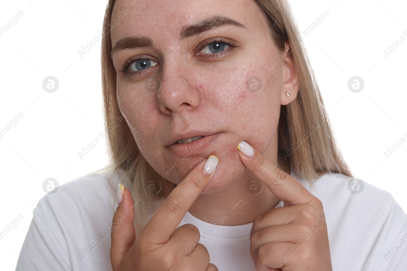 Woman popping pimple on white background. Acne problem Photo of Woman popping pimple on white background. Acne problem