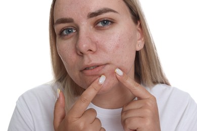 Photo of Woman popping pimple on white background. Acne problem