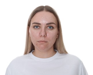 Photo of Woman with acne problem on white background