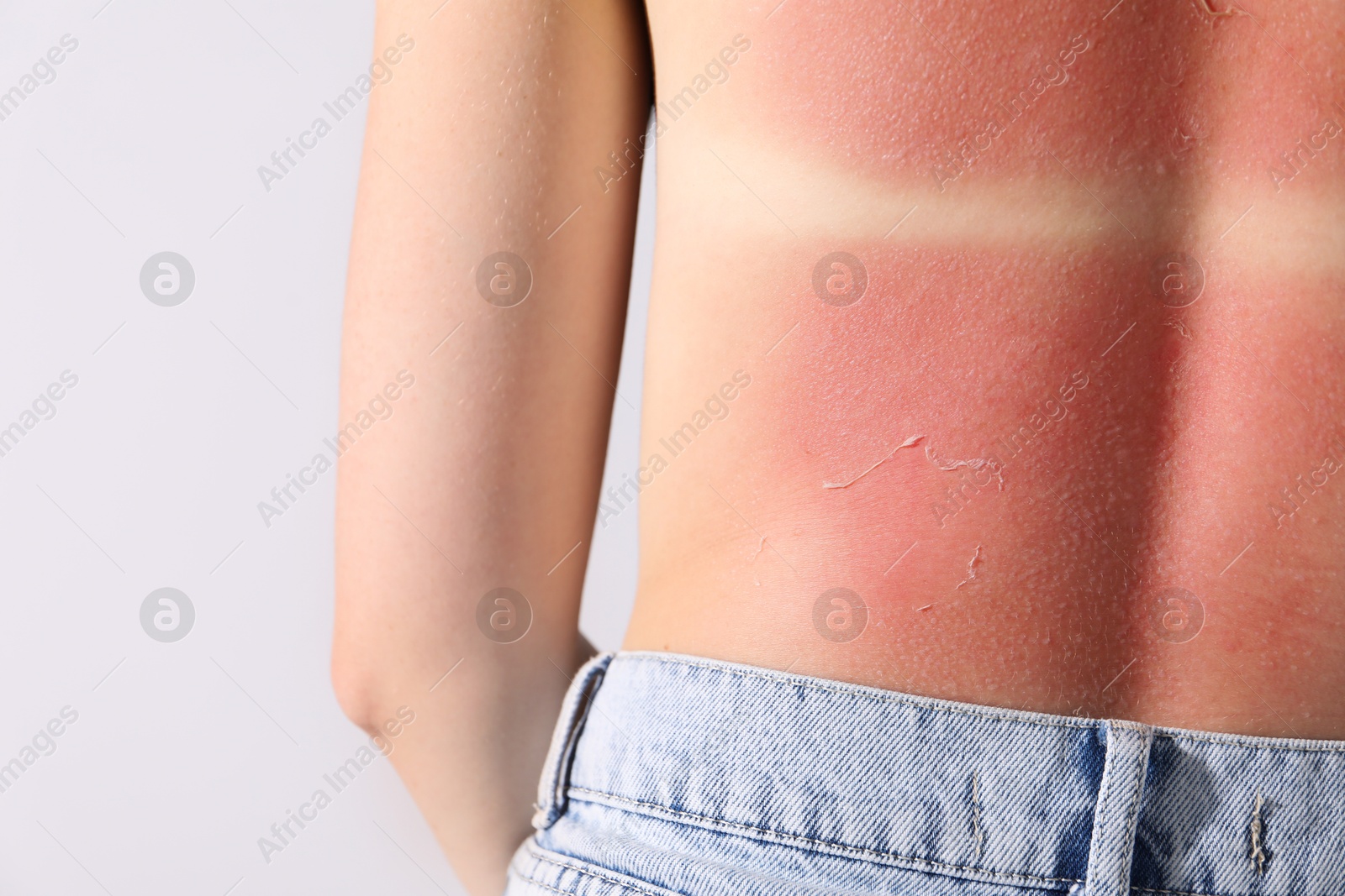 Woman with peeling skin from sunburn on light background, closeup Photo of Woman with peeling skin from sunburn on light background, closeup