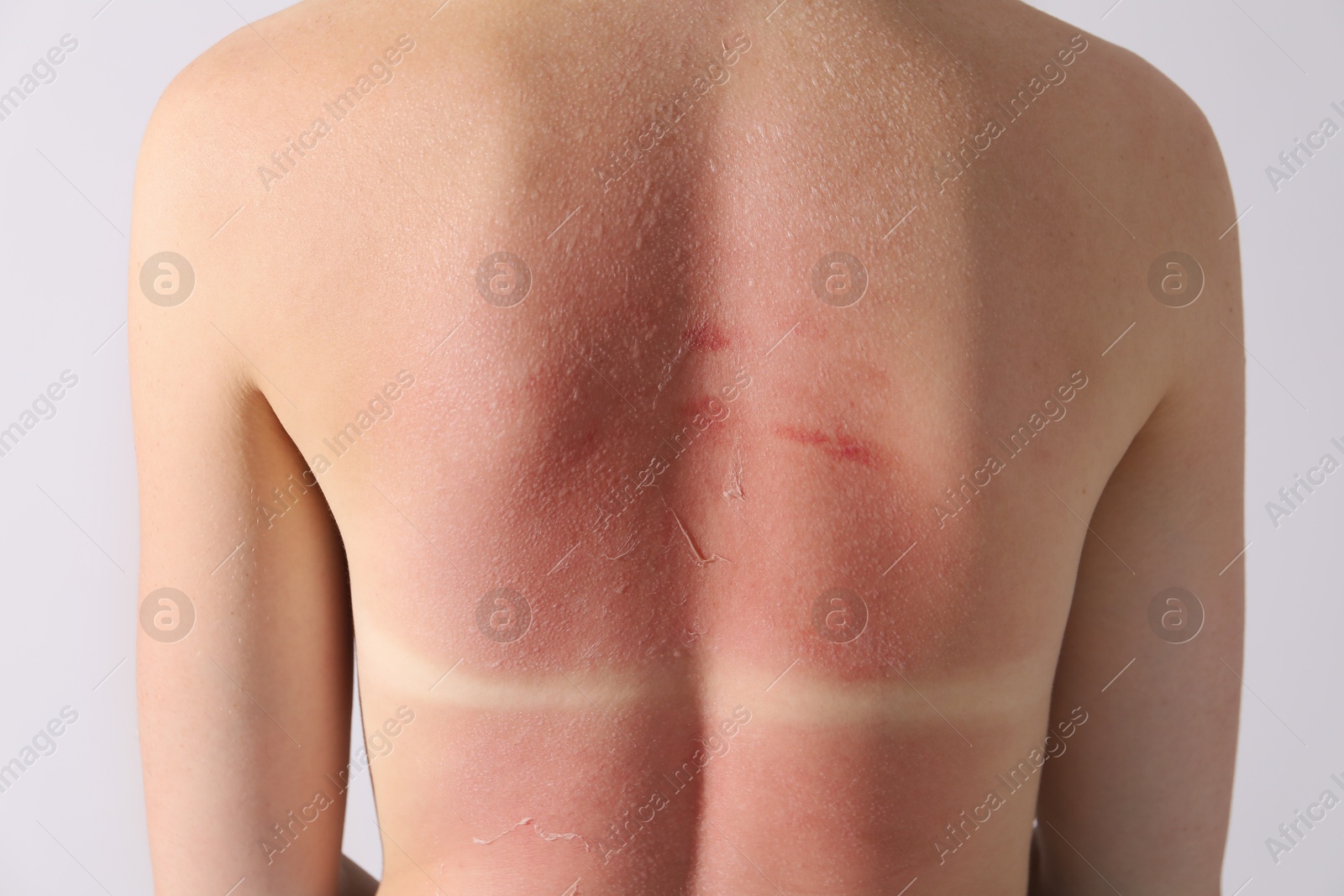 Photo of Woman with peeling skin from sunburn on light background, closeup