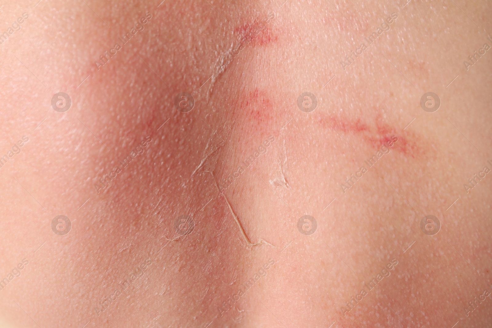 Woman with peeling skin from sunburn, closeup Photo of Woman with peeling skin from sunburn, closeup