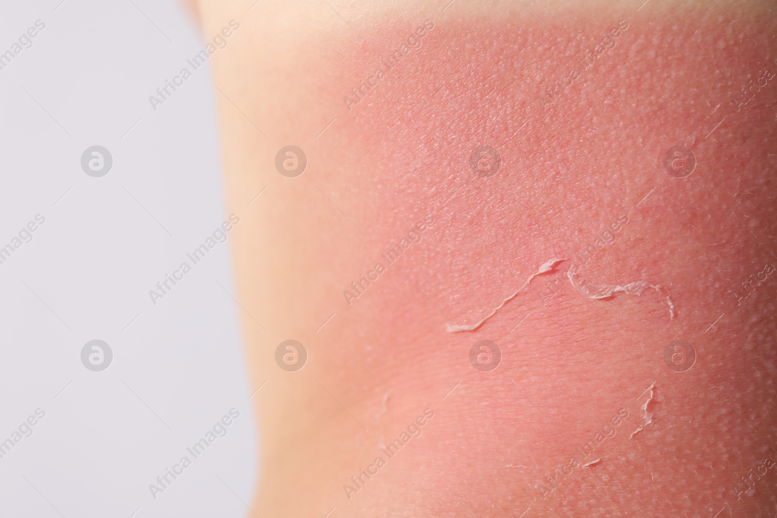 Photo of Woman with peeling skin from sunburn on light background, closeup
