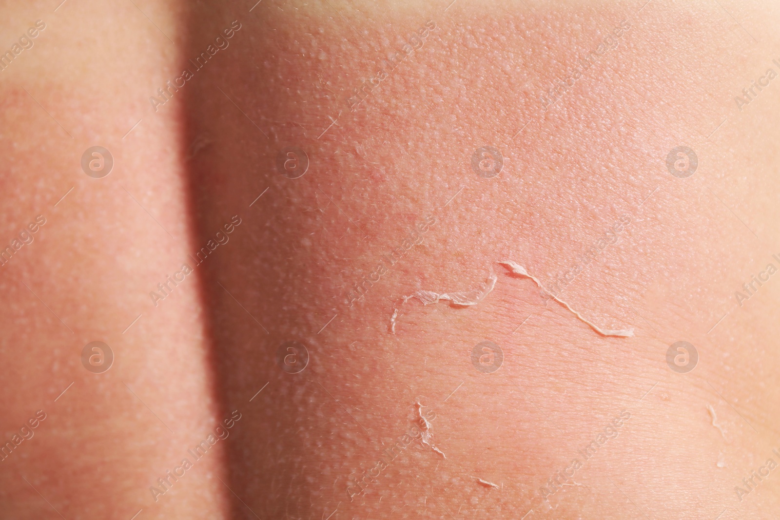 Woman with peeling skin from sunburn, closeup Photo of Woman with peeling skin from sunburn, closeup