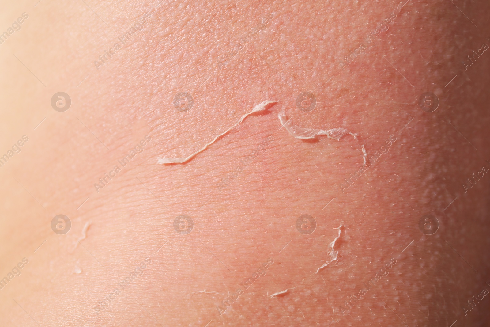 Woman with peeling skin from sunburn, closeup Photo of Woman with peeling skin from sunburn, closeup