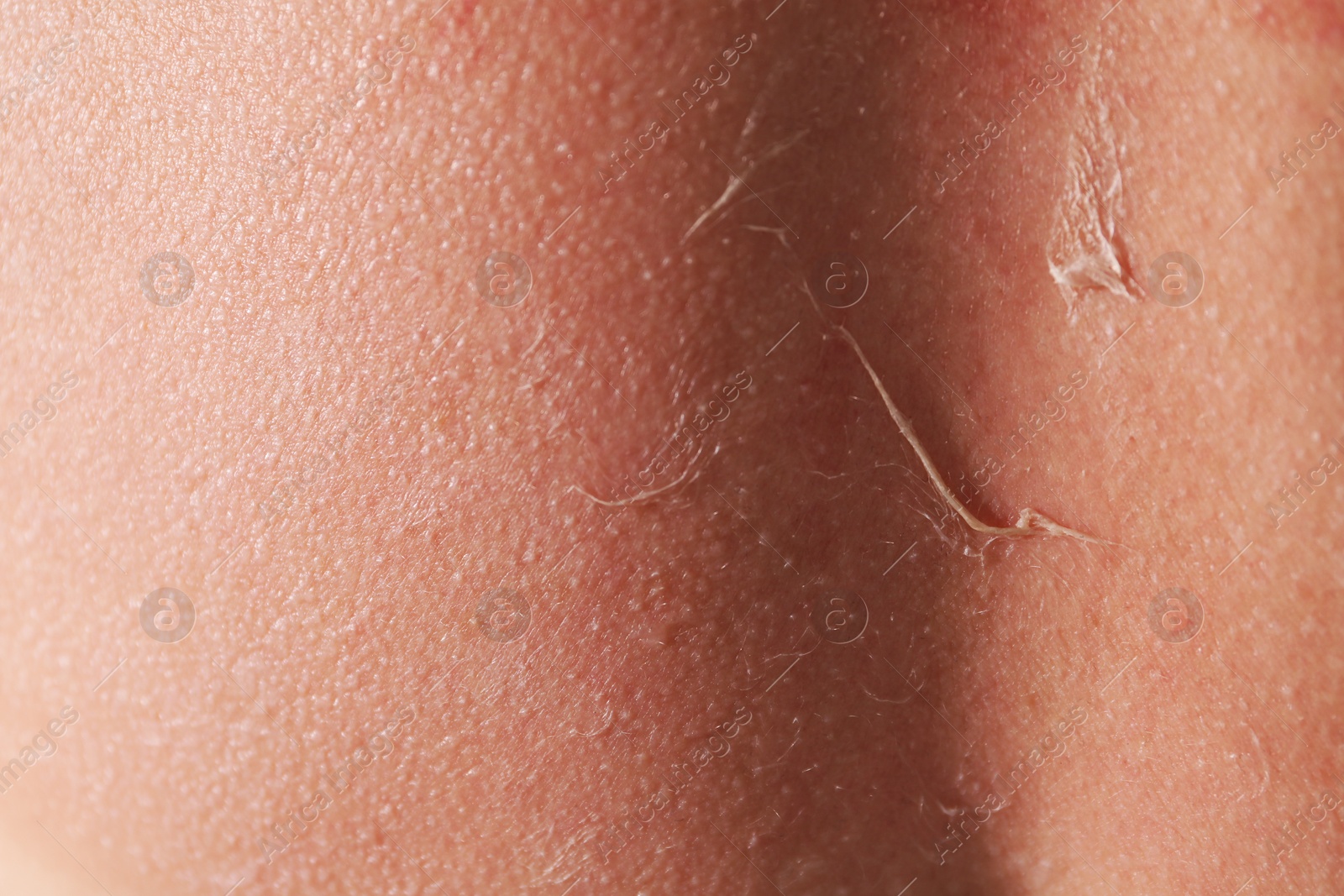 Woman with peeling skin from sunburn, closeup Photo of Woman with peeling skin from sunburn, closeup