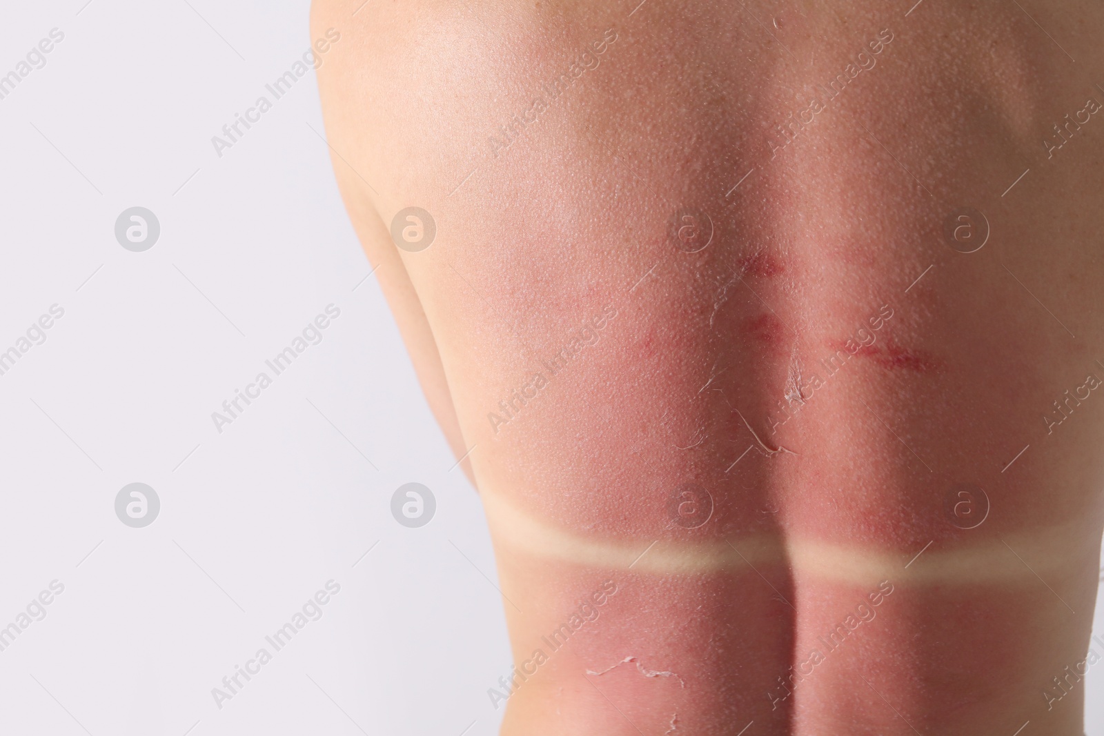 Woman with peeling skin from sunburn on light background, closeup Photo of Woman with peeling skin from sunburn on light background, closeup