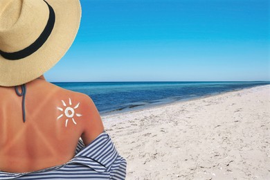 Image of Woman with sunburned skin on beach, back view. Soothing cream in shape of sun on her body