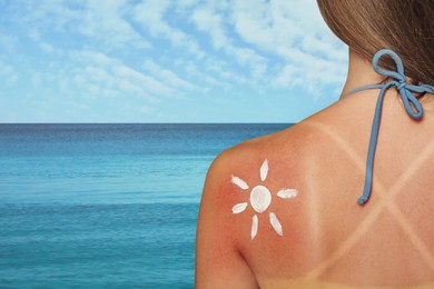 Image of Woman with sunburned skin on beach, back view. Soothing cream in shape of sun on her body