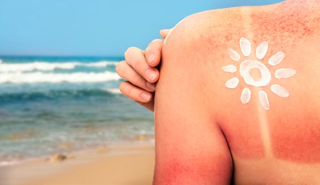 Image of Woman with sunburned skin on beach, back view. Soothing cream in shape of sun on her body