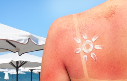 Image of Woman with sunburned skin on beach, back view. Soothing cream in shape of sun on her body