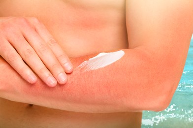 Image of Man with sunburned skin applying soothing cream on hand, closeup